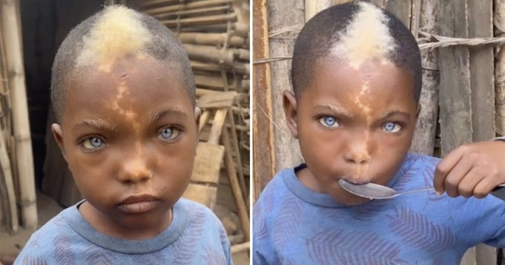 Little boy with natural blue eyes, white hairs and lightning mark down his face goes viral
