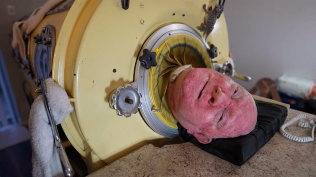 76-year-old man, paralyzed from polio at 6, is one of the last people with an iron lung: ‘My life is incredible’